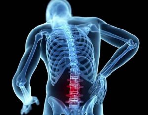 Hẹp ống sống thắt lưng là bệnh lý cơ xương khớp thường gặp ở nhiều đối tượng