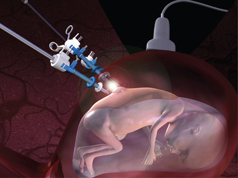 Phẫu thuật gai đôi cột sống được thực hiện khi bệnh đã có những biến chứng nguy hiểm đến hệ thần kinh của thai nhi.