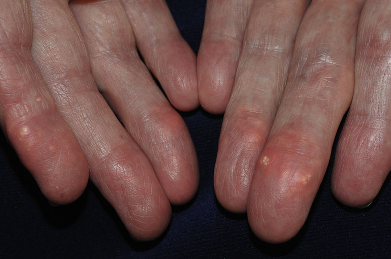 Hạt dưới da trong viêm khớp dạng thấp là một trong những biến chứng phổ biến hiện nay.