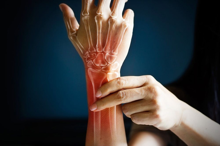 Viêm khớp cổ tay là tình trạng dây chằng, mô sụn, màng bao hoạt dịch, đầu xương, dây thần kinh…