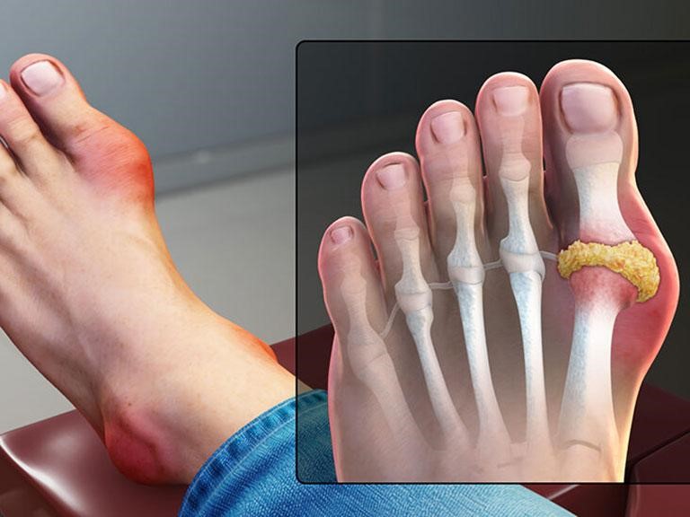 Gout là nguyên nhân chính gây viêm khớp cổ tay, cổ chân.