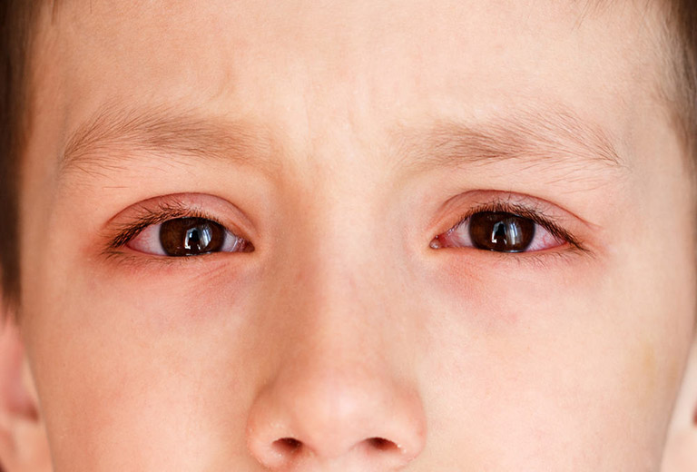 Bệnh có thể gây ra những biến chứng nguy hiểm về mắt cho trẻ.
