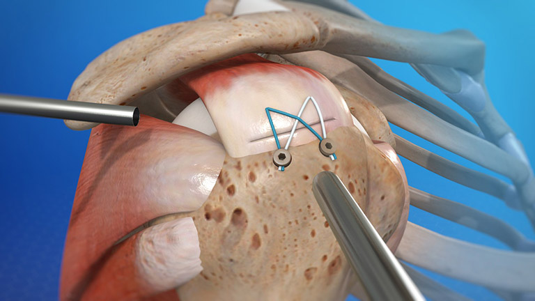 Phẫu thuật nối gân là phương pháp phổ biến nhằm phục hồi chức năng vận động của khớp.
